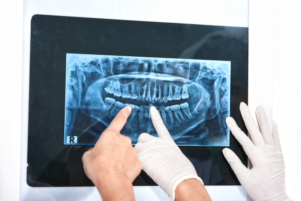 La ce riscuri mÄƒ supun dacÄƒ recurg la radiografiile dentare?