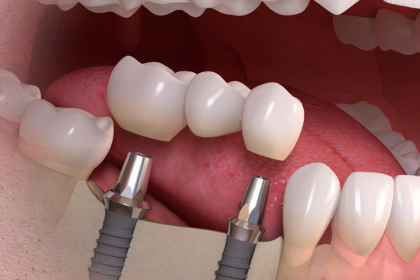Implantul dentar - riscuri și contraindicații
